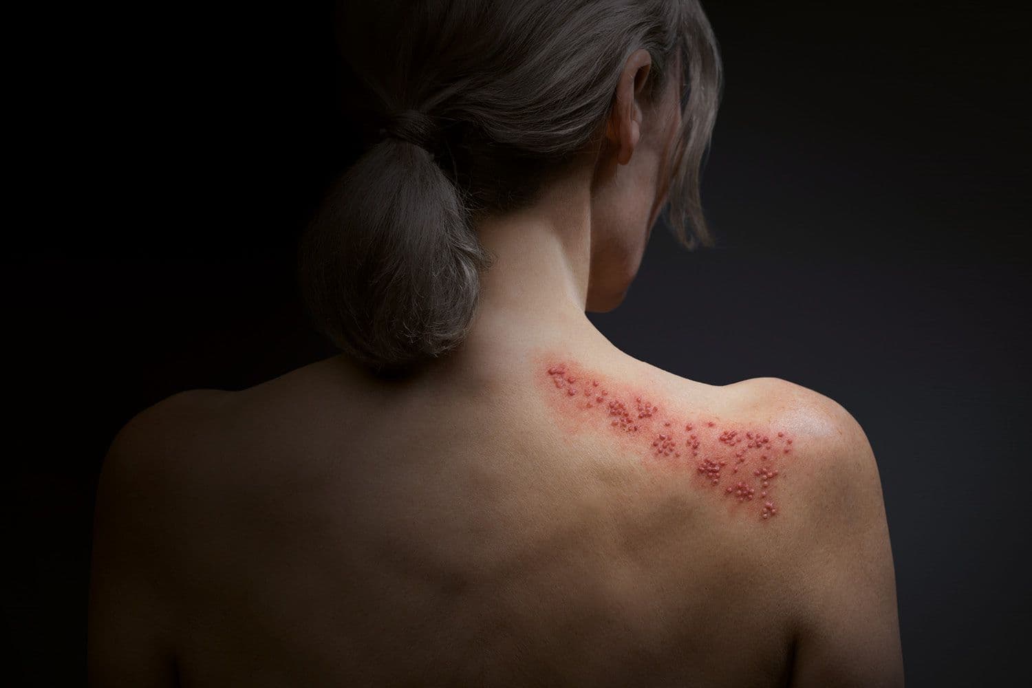 Eine Frau mit rosen Punkten am Rücken. Sie leidet unter Gürtelrose.